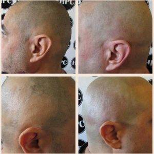 Alopecia Scar Repair