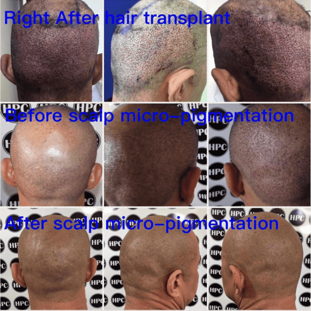 hair-transplant-scar-repair