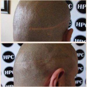 hair-transplant-strip-scar-repair