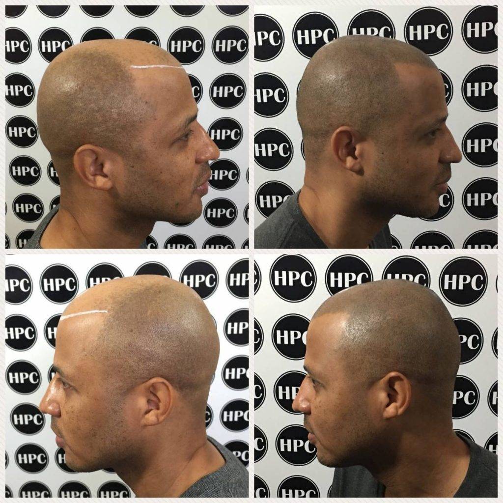 scalp-micropigmentation-florida (27)