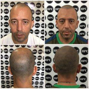 scalp-micropigmentation-florida (3)