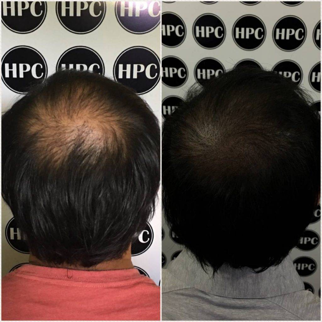 scalp-micropigmentation-florida (35)