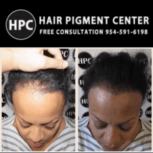 scalp-micropigmentation-florida-women (1)