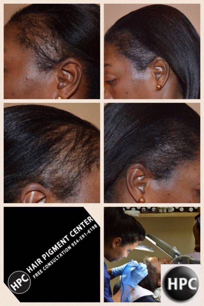 scalp-micropigmentation-florida-women (1)