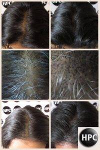 scalp-micropigmentation-florida-women (2)