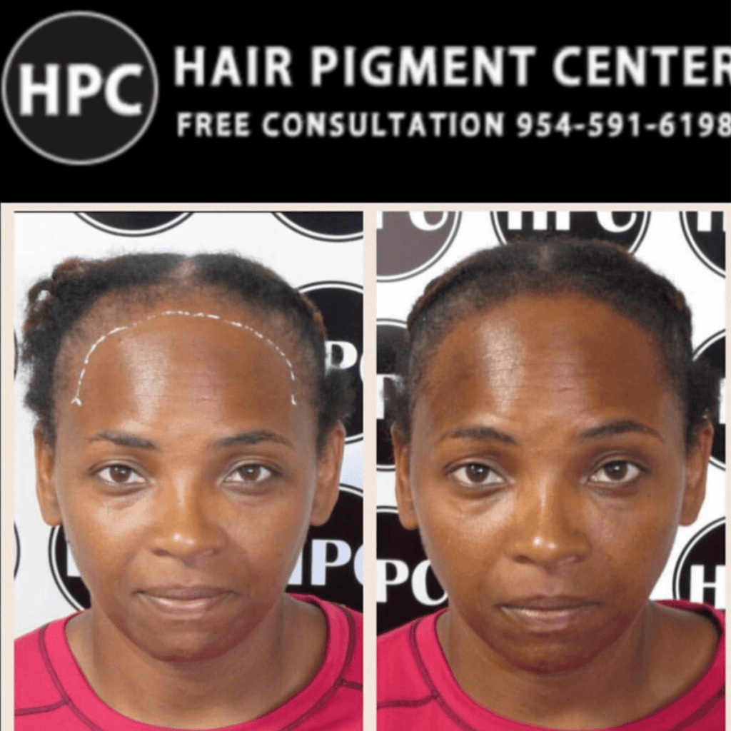 scalp-micropigmentation-florida-women (3)