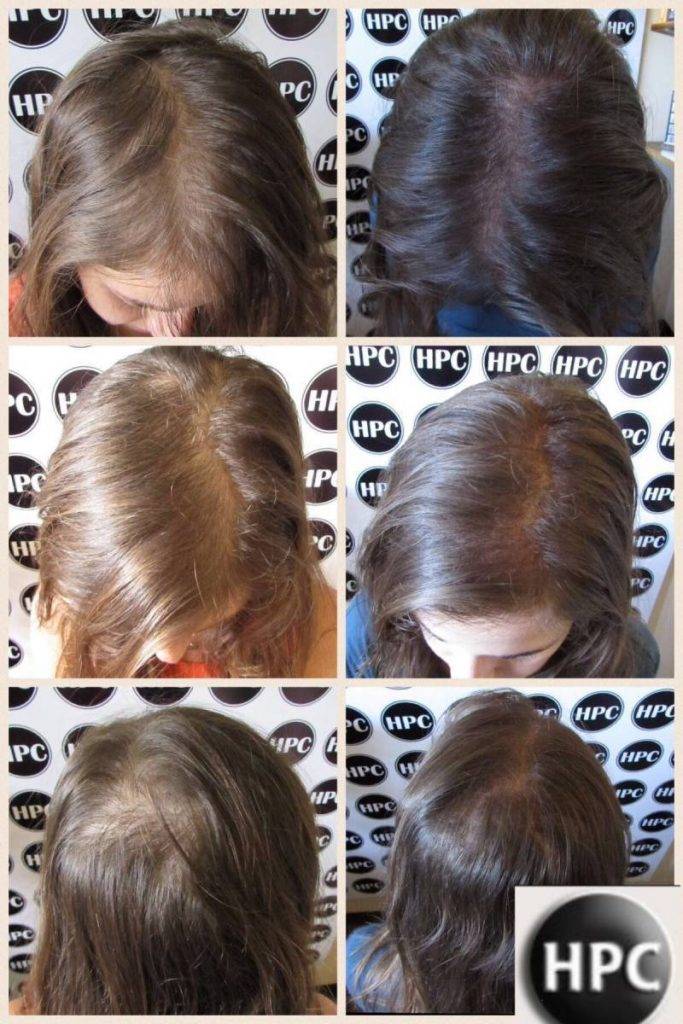 scalp-micropigmentation-florida-women (3)