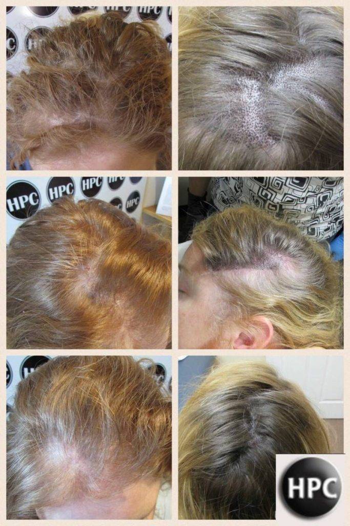 scalp-micropigmentation-florida-women (4)