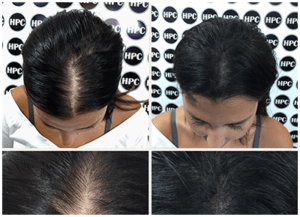 Increase Hair Density